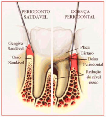doenca periodontal e diabetes